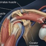 rupture du tendon